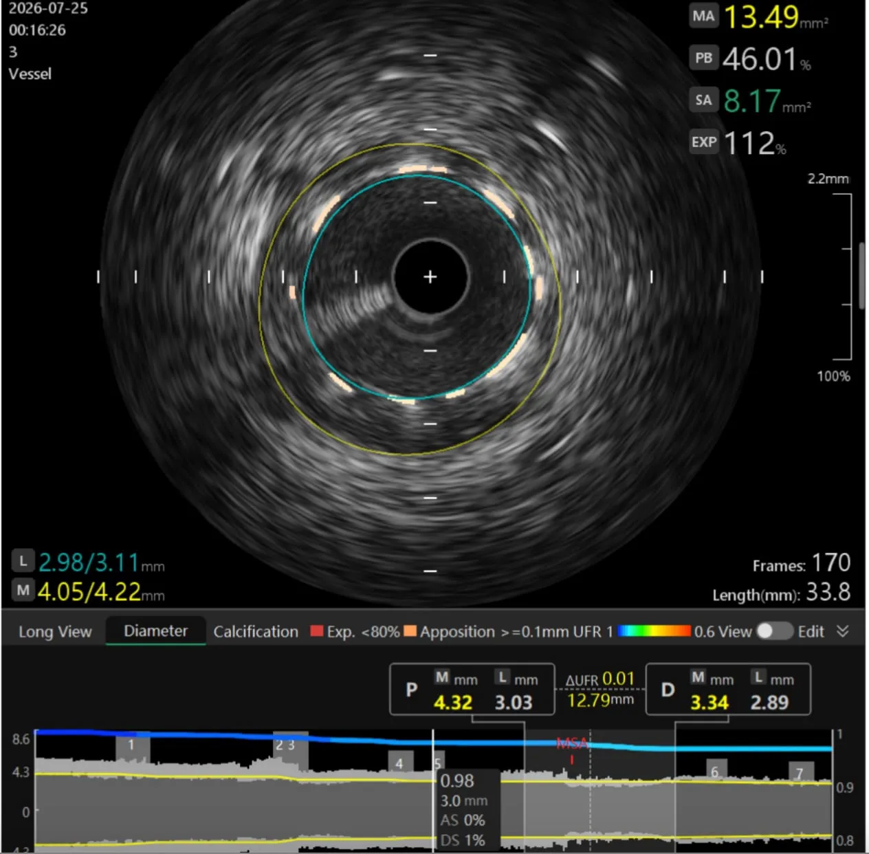 CEDIMAT realiza el primer procedimiento de litotricia intravascular coronaria con balón del país